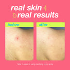 clarifying bacne spray